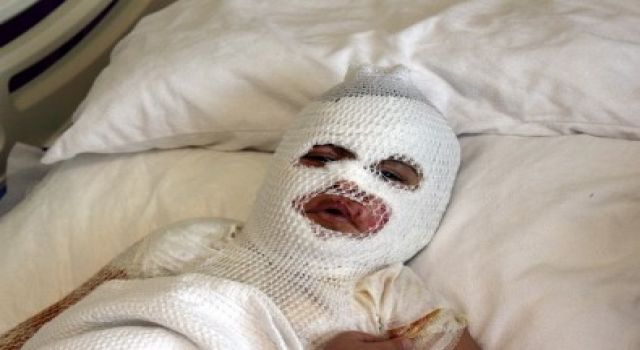 Başından aşağıya kaynar su dökülen çocuk feci şekilde yandı