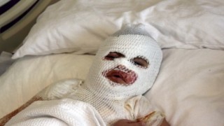 Başından aşağıya kaynar su dökülen çocuk feci şekilde yandı